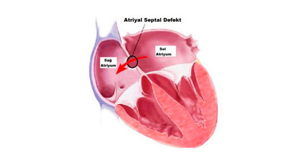 Atrial Septal Defekt